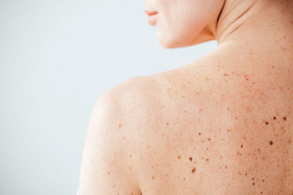 Ελιές δέρματος - Πότε είναι επικίνδυνες