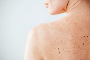 Ελιές δέρματος - Πότε είναι επικίνδυνες